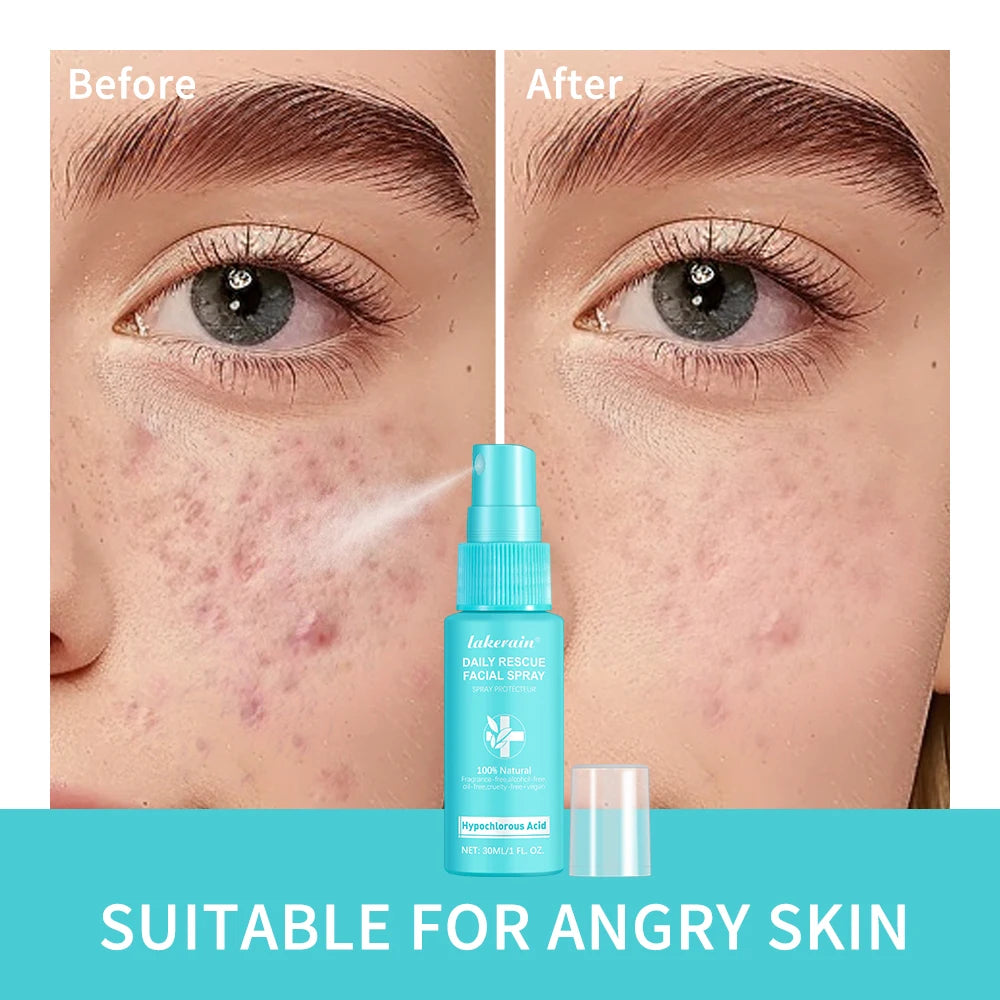 Ph Balancing Facial – Spray – Hypochlorous Acid Soothing Toner✨