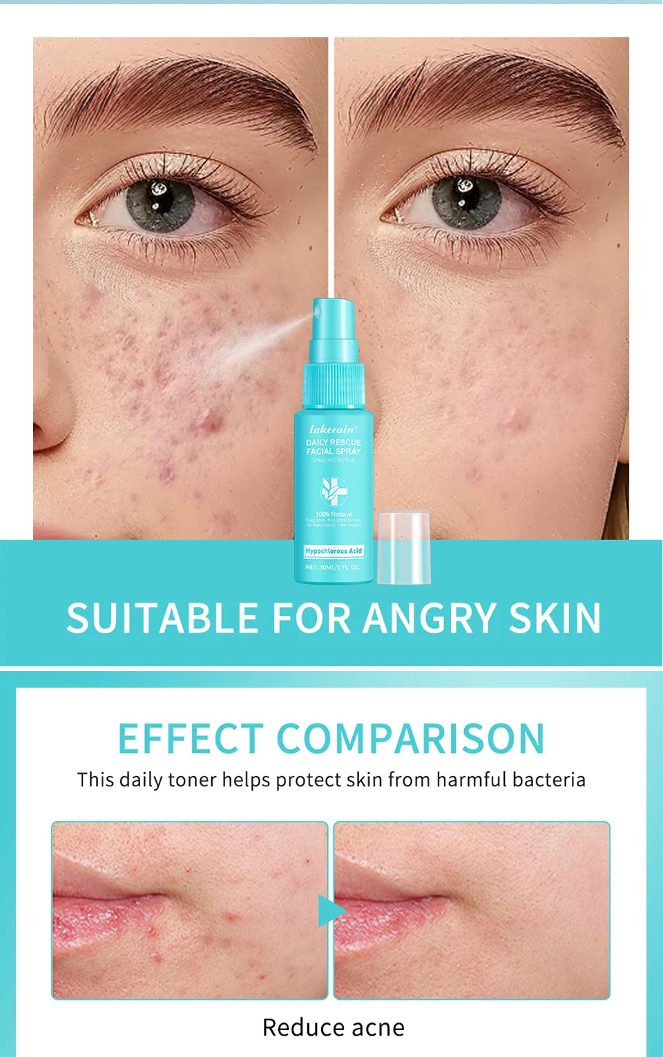 Ph Balancing Facial – Spray – Hypochlorous Acid Soothing Toner✨