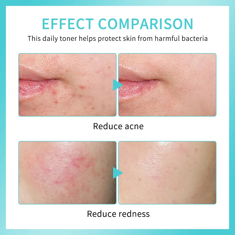Ph Balancing Facial – Spray – Hypochlorous Acid Soothing Toner✨