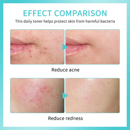 Ph Balancing Facial – Spray – Hypochlorous Acid Soothing Toner✨